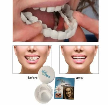 Snap on Smile Teeth Whitening veneers (Perfect Smile)