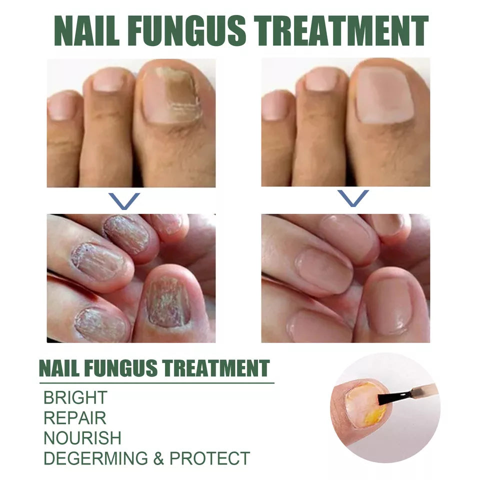 Fast Nail Fungal Treatments Nail Repair Essences Serum